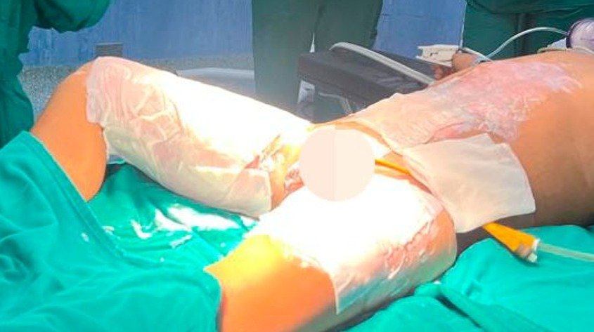 12. Epicitehydro© para el tratamiento conservador de heridas en niños con quemaduras de segundo grado