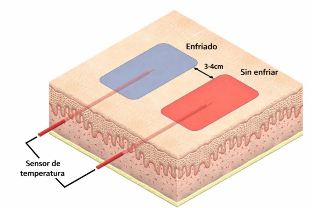 2. Un nuevo modelo de quemadura humana ex vivo y el efecto de enfriamiento local de un apósito para heridas basado en nanocelulosa bacteriana