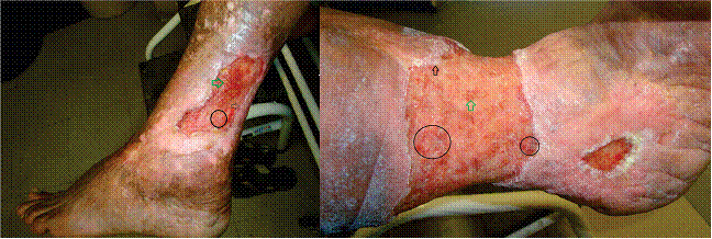 22. Eficacia de la membrana de celulosa bacteriana para el tratamiento de úlceras varicosas crónicas de miembros inferiores: Un ensayo aleatorizado y controlado