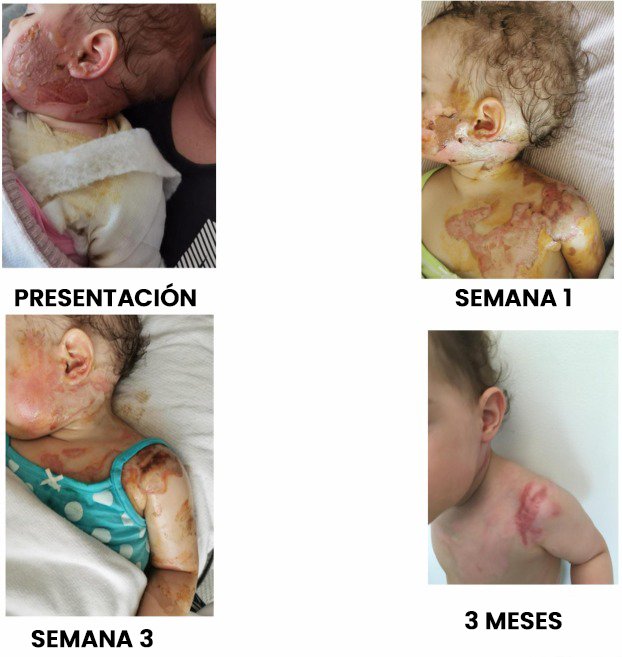 24. Apósito de celulosa biosintética de una sola etapa y primera capa versus gasa no adherente para el tratamiento de quemaduras pediátricas