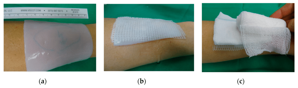 26. El impacto de un apósito a base de nanocelulosa en el tratamiento de lesiones térmicas en niños: resultados de una evaluación retrospectiva
