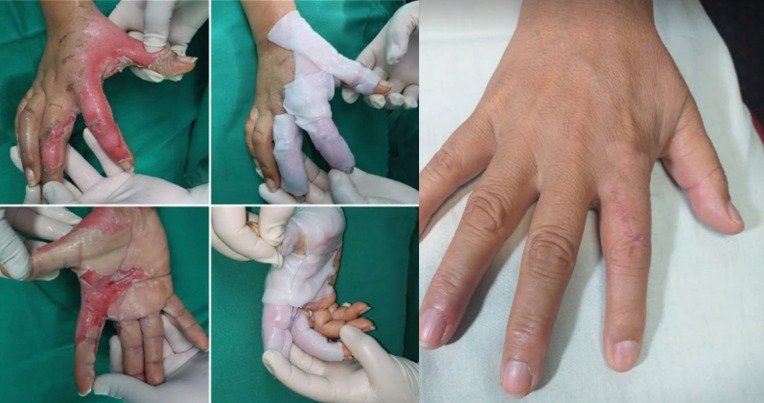 3. Evaluación de la cicatrización en áreas de quemaduras de segundo grado con el uso de xenoinjerto en comparación con sustituto de piel de celulosa sintética