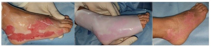 6. Tratamiento de quemaduras con BNC (bacterias nanocelulosas) Epicite: Experiencia clínica inicial con un nuevo producto