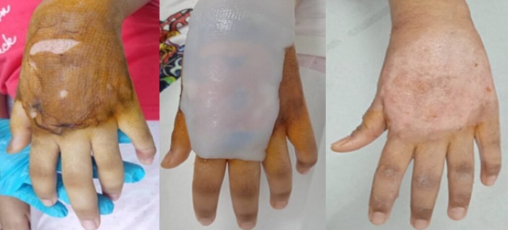 9. Experiencias con Epicite en la aplicación cotidiana en un centro de grandes quemados